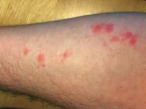 Bed Bug Bites Vs Flea Bites: How To Tell The Difference (Video)