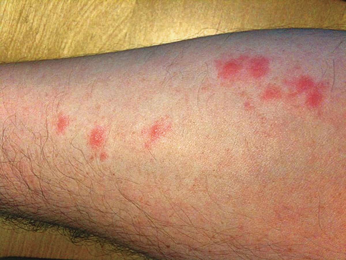 Bed Bug Bites Vs. Flea Bites [How To Tell The Difference]