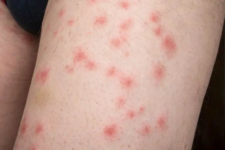cluster of bug bites that itch