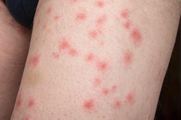 cluster of bug bites that itch