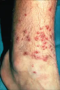 What Do Chigger Bites Look Like?